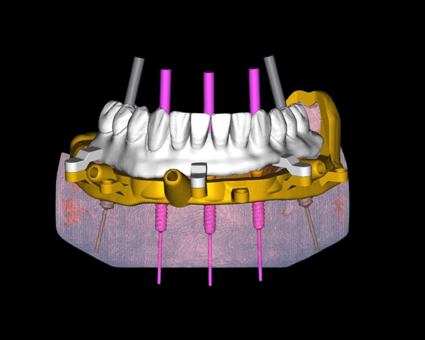 Planeamento de Implantes