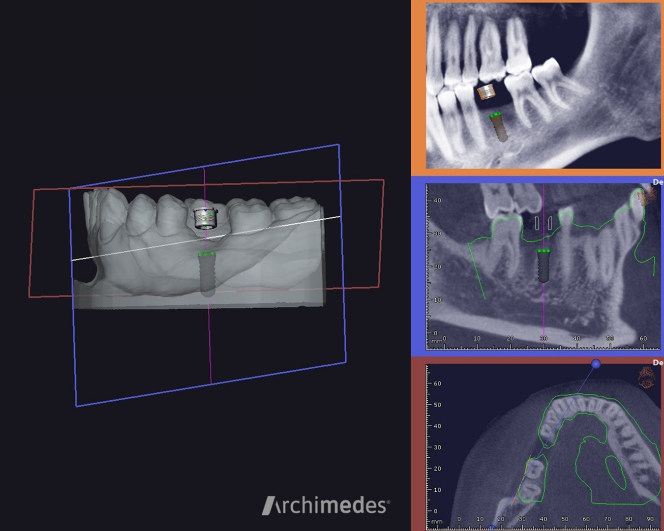 Planeamento Digital de Implantes